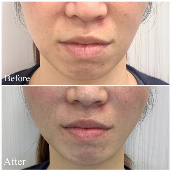 アスク美容クリニック銀座_症例写真