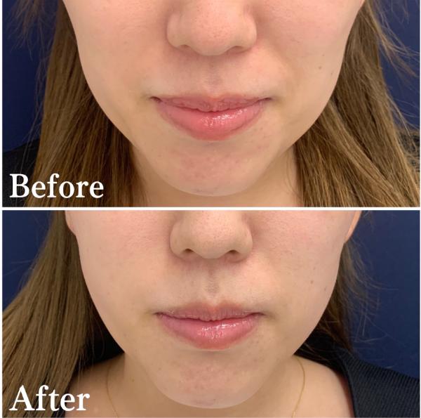 アスク美容クリニック銀座_症例写真