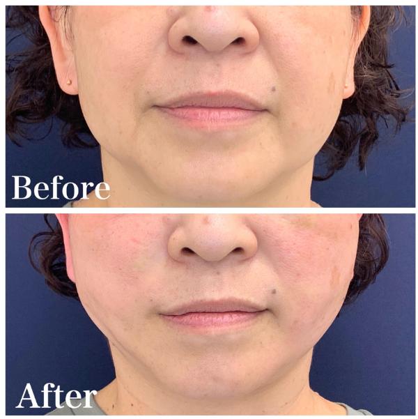 アスク美容クリニック銀座_症例写真