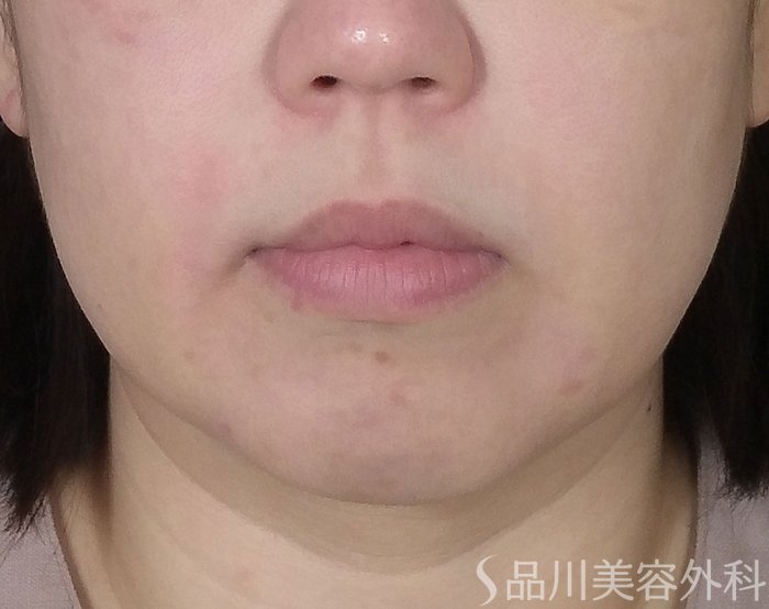 品川美容外科_症例写真