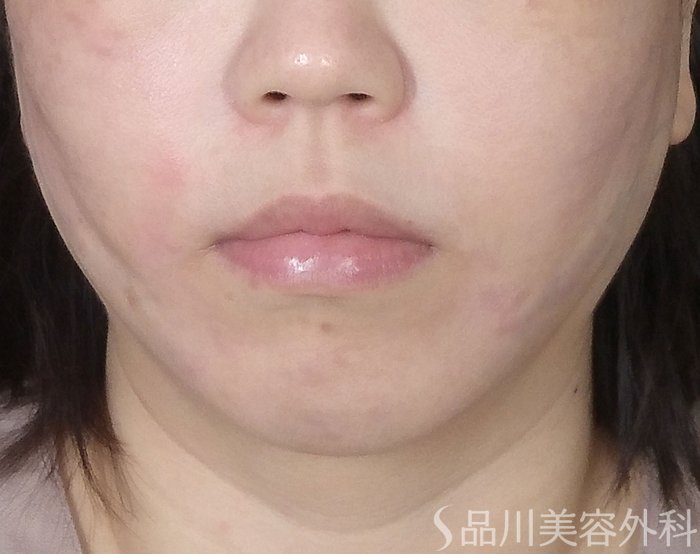 品川美容外科_症例写真