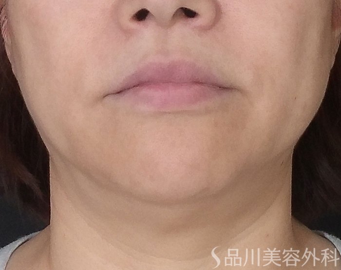 品川美容外科_症例写真