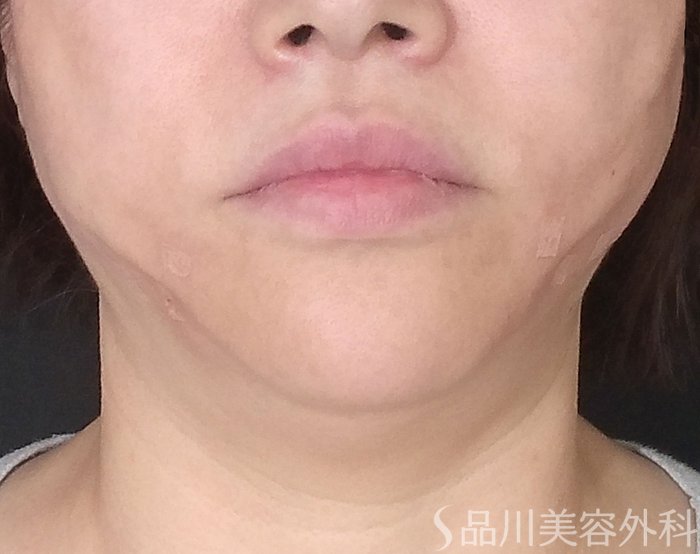 品川美容外科_症例写真