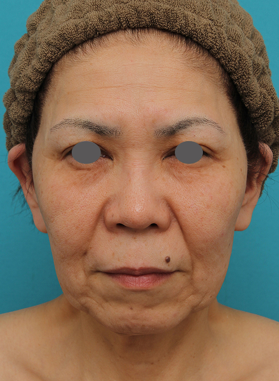 高須クリニック_症例写真