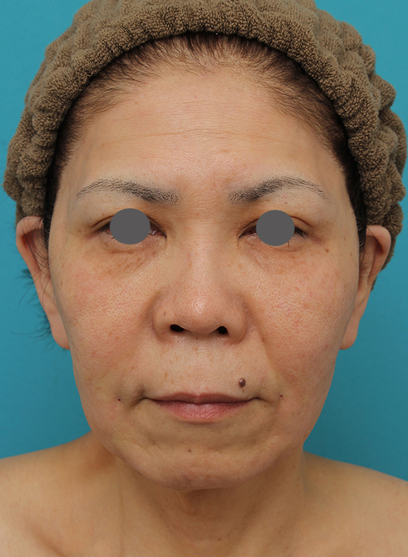 高須クリニック_症例写真