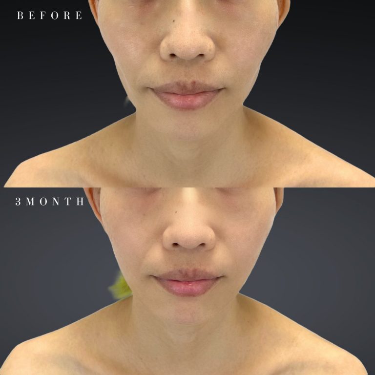 TCB東京中央美容外科_症例写真