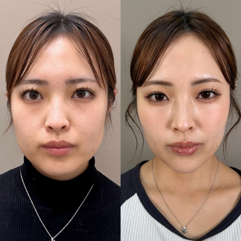 TCB東京中央美容外科_症例写真